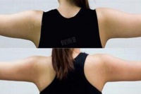 吸脂整形手术方法