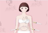 想知道深圳今喜医疗斯良洪医生吸脂多少钱？多种方式价格及医院优势全揭秘