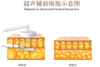 李增辉吸脂价格表靠谱吗？腰腹/大腿吸脂5k