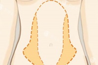 罗明生吸脂收费标准大公开！2026单部位吸脂5000元起、腰腹环吸13000元起、全身吸脂20000元起