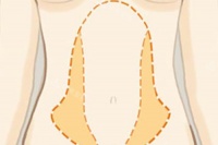 韩国口碑吸脂医院名单：集美实测365mc/Qline腰腹大腿环吸，术后不反弹不凹凸！