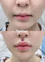 杭州李增辉吸脂技术咋样？20年经验+先进技术，术后效果稳定价格亲民！