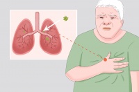 肺癌病人的最佳食谱