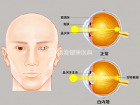 白内障