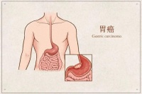 得了胃癌能治愈吗？如何治疗？这9类人是高危人群，做好早期预防