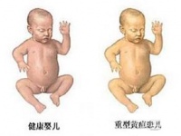 新生儿黄疸高，哺乳妈妈饮食注意什么？