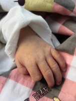 如何预防急性乳腺炎