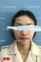 肉毒素，国产衡力VS进口保妥适，区别到底在哪里？