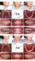 【科普】儿童早期矫治的选择和误区