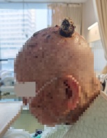 97 岁老人头顶长了「树桩」，散发恶臭，切了还会继续长