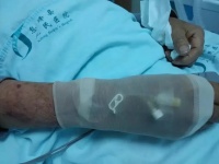 非计划性拔管总是防不胜防？不妨来试试这些预防措施~