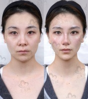 哈尔滨领艺医疗美容医院上臂/面颊/下颌缘/双下巴等小部位吸脂价格3980元起，医生经验丰富保障术后效果自然美观
