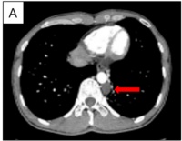 10分钟微创，次日就能出院！这家医院的先进技术助力患者快速康复