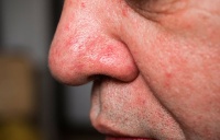 用了去角质脸部刺痛发红