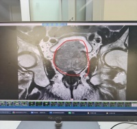83岁老人尿频10年竟拖成尿毒症！泌尿外科专家提醒：出现这些信号千万别硬扛