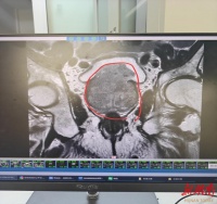 83岁老人尿频10年，竟拖成尿毒症——这些信号千万别硬扛