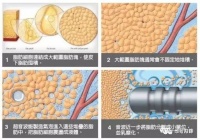 【吸脂塑形】微创吸脂+超声波溶脂 联合治疗颈后脂肪垫（富贵包）
