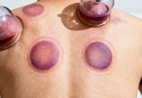 拔罐減肥、排毒效果好？醫(yī)生揭秘拔罐背后的健康益處