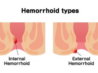 吃了碧生源便血怎么辦