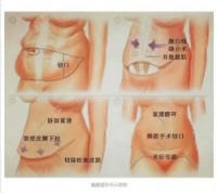 腹壁成形术的功效与手术方法