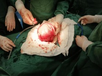 警惕！月經(jīng)紊亂、腹部包塊別忽視，47歲女士因子宮肌瘤行全子宮切除術(shù)，這些信號(hào)要警惕