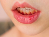 口碑俱佳：郑州新世纪医院hpV“刚刚发布”尖锐湿疣反复发作？可能是这几个习惯没改对