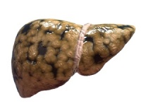 脂肪肝患者可以吃蜂蜜吗