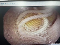 內(nèi)鏡下驚現(xiàn)一個「8」，到底是什么？站友：現(xiàn)在不多見了