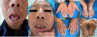 雙手被「潑墨」，狂搓不掉！檢測(cè)卻一切正常？主任：罕見中的罕見，直接發(fā)刊