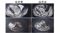 儿童肿瘤之王如何实现精准治疗？河北一洲肿瘤医院专家分享神经母细胞瘤质子治疗实践