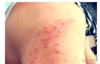 湿热型皮肤病外洗方（黄苦汤）使用介绍