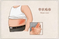 科普｜带状疱疹疼痛难忍？带您了解针灸治疗