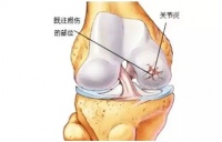 膝关节炎的居家康复训练 康复科